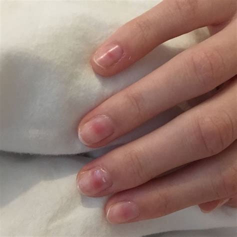 Astrazeneca lässt sich leichter transportieren und lagern. Rote Flecken unter den Fingernägeln, was tun? (Gesundheit ...