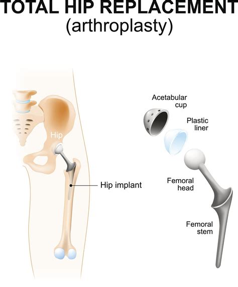 Types Of Total Hip Replacement Doctorvisit
