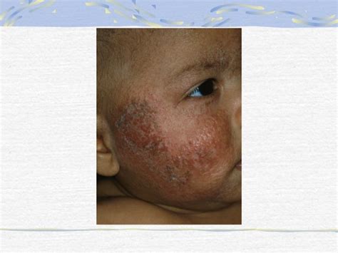 Paediatric Rash