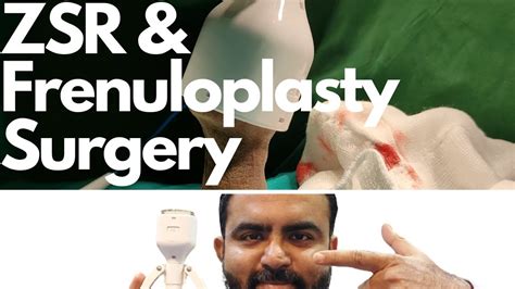 frenuloplasty and zsr circumcision by dr sachin kuber 919370275336 919370240098 youtube