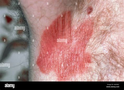 Erythrasma Close Up Of A Red Patch Of Skin In A Mans Armpit Caused By