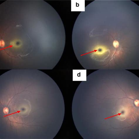 Ocular Fundus Photographs A Left Eye Of Patient 1 B Right Eye Of
