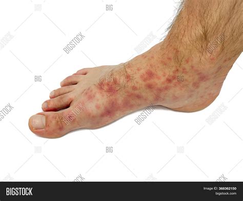 Red Rash On Feet Male Image And Photo Free Trial Bigstock
