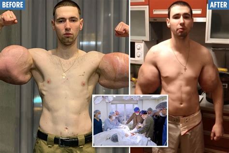 Mma Bodybuilder Popeye Shows Off His Arm After Gruesome Surgery To Have His Rotting Oil Filled