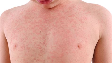 How To Get Rid Of Heat Rash And Prickly Heat In Children And Adults