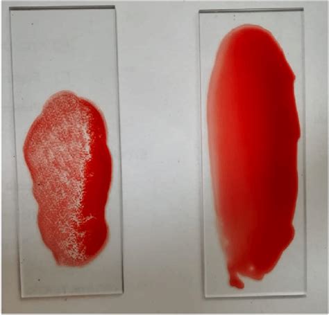 Cold Agglutination Test Showing Agglutination In The Test Positive