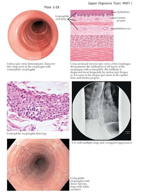 Eosinophilic Esophagitis Pediagenosis