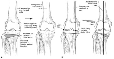 Fulkerson Osteotomy Management Of The Posttraumatic Arthritic Knee