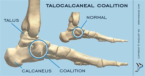 What Is Tarsal Coalition Mass4d® Foot Orthotics