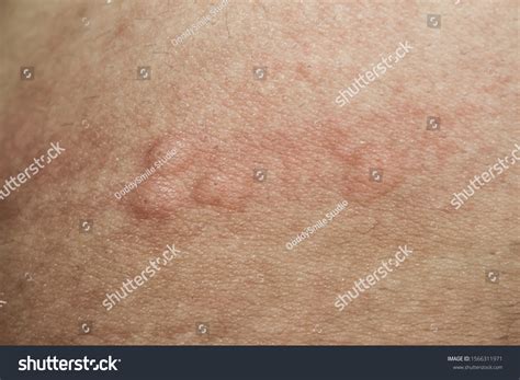 Urticaria On Skin Rashes Which Urticaria Stock Photo Edit Now 1566311971