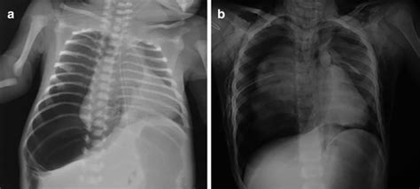 2 Tension Pneumothorax In An Infant A And In An Older Child B On