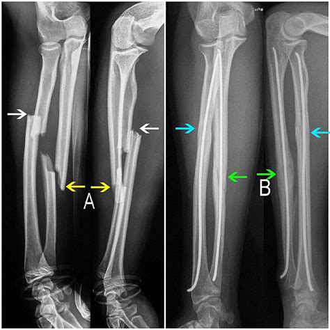 Cureus Retrograde Fixation Of The Ulna In Pediatric Forearm Fractures