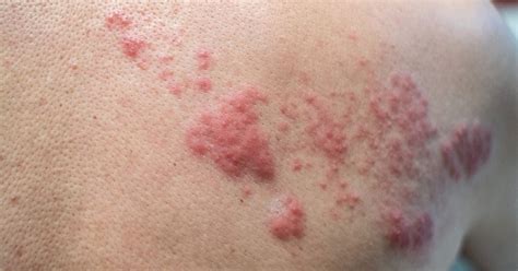 Top 12 How Long After Shingles Vaccine Are You Contagious In 2022