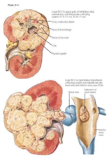 Gross Pathologic Findings In Renal Cell Carcinoma Renal Cell