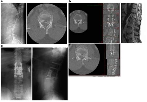 A Patient With A L1 Burst Fracture And Significant Retropulsion Of The