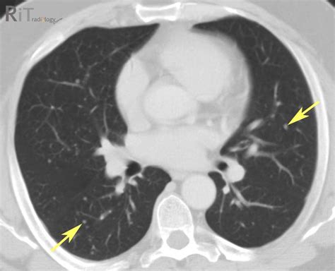 Rit Radiology Miliary Pulmonary Metastasis