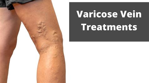 Treatment For Varicose Veins Youtube