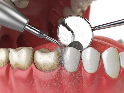 When Do You Need Deep Teeth Cleaning Dental Implant And Aesthetic