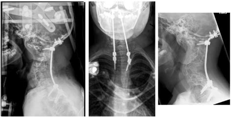 Post Operative Lateral Left And Posterior Anterior Radiographs