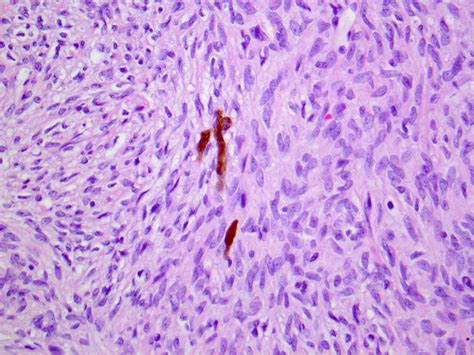 Pathology Outlines Dermatofibrosarcoma Protuberans Dfsp