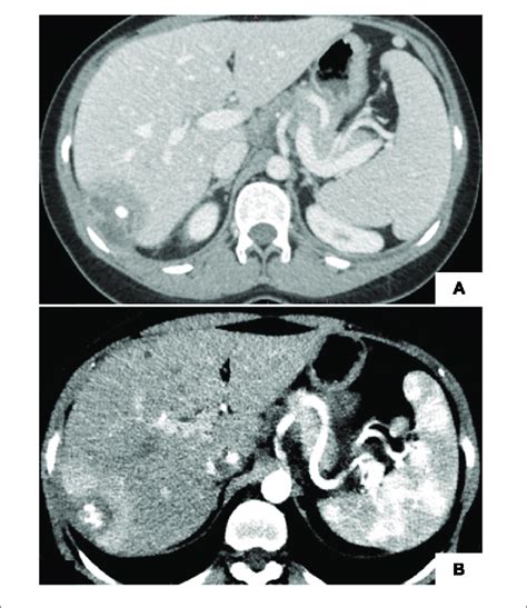 Abdominal Ct Scans Showing Liver Abscess A Central Calcification