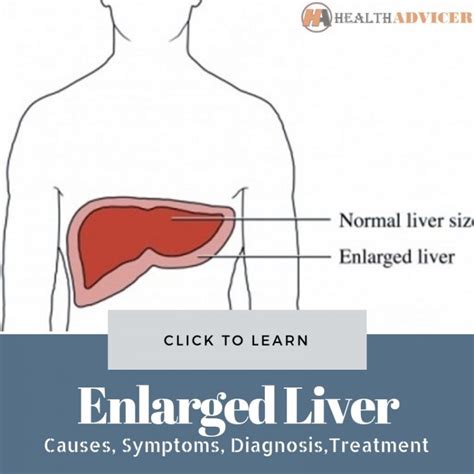 Enlarged Liver Causes Picture Symptoms And Treatment