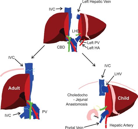 Liver Transplant Diagram