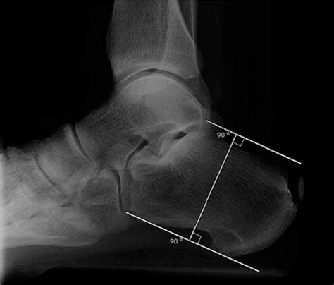 Insertional Achilles Tendinitis And Haglund S Deformity Steve Kang