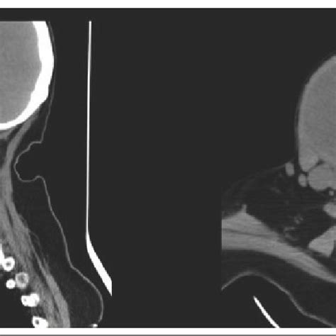 Computed Tomography Scan Of The Neck Without Intravenous Contrast