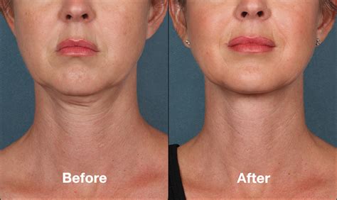 Tacoma Laser Clinic Kybella Treatment For Submental Fat