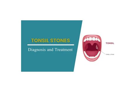 How To Get Rid Of Tonsil Stones Forever Digi Health Box