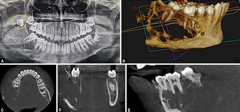 Odontogenic Myxoma With Displaced Third Molar To Coronoid Process Role