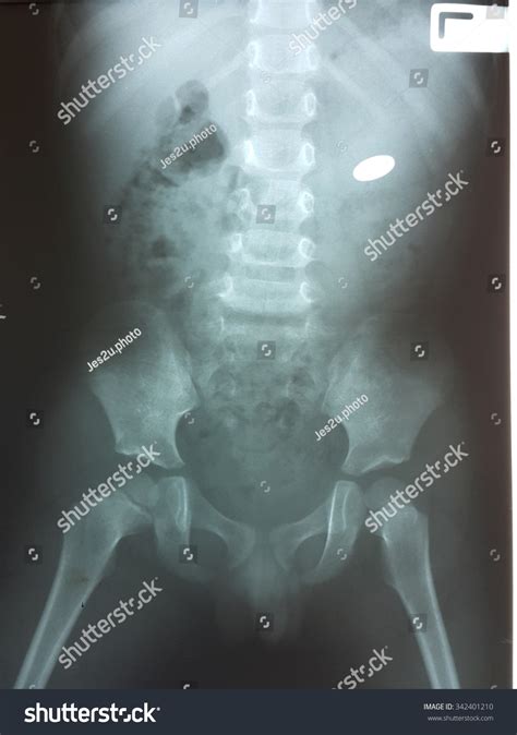 Xray Image Child Swallowed Coins Medical Stock Photo 342401210