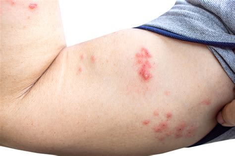Skin Infected Herpes Zoster Virus On Woman Arm Stock Photo - Download ...