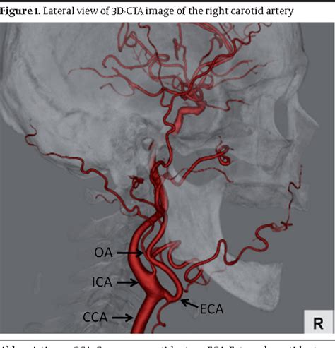 Pdf Occipital Artery Arising From The Anterior Aspect Of The Internal