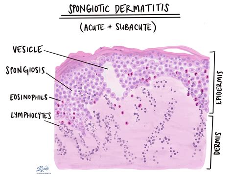 Spongiotic Dermatitis Mypathologyreportca