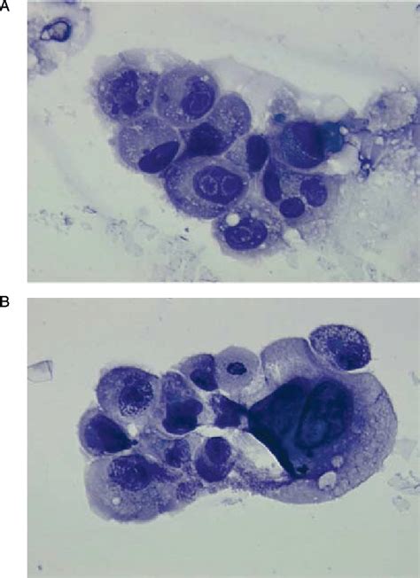 Anaplastic Thyroid Cancer Cytology Cancerwalls