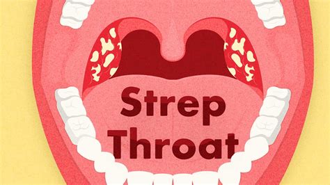 Strep Throat Symptoms And Related Conditions Ausmed