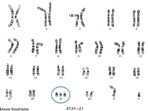 This diagnosis, post karyotype test, is important because there are some children who may exhibit soft. Trisomy 21 karyotype | Trisomy 21, Down syndrome, Math