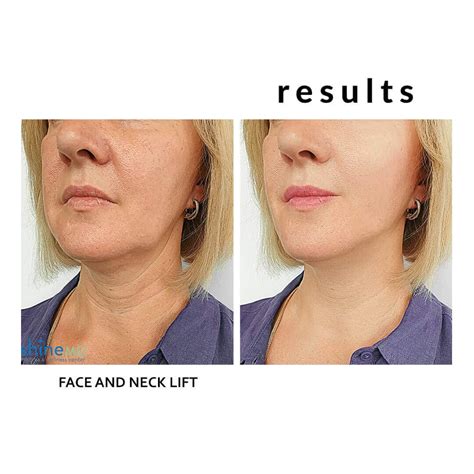 How Does Pdo Threadlift Works And The Before And After Results