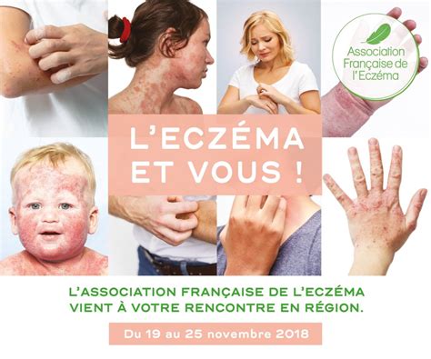 La Semaine Eczéma And Vous Association Française De Leczéma