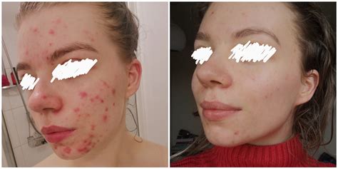 Banda 6 Months Progress On My Severe Hormonal Acne More Info In