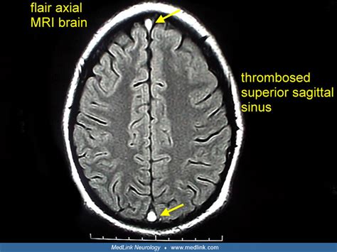 Cerebral Venous Thrombosis Cvt Medlink Neurology