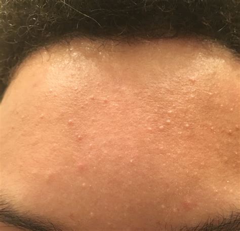 I Have Had These Red Spots On My Forehead For A Few Months Now And I