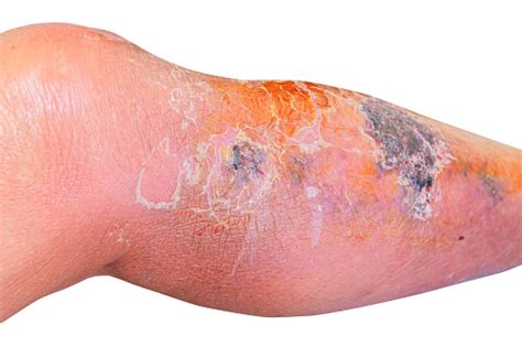 Erysipelas Bacterial Infection Under The Skin Leg Andngout Foot Aged