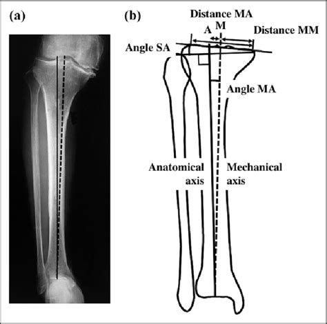 A An Anteroposterior View Radiograph Of The Typical Tibia With