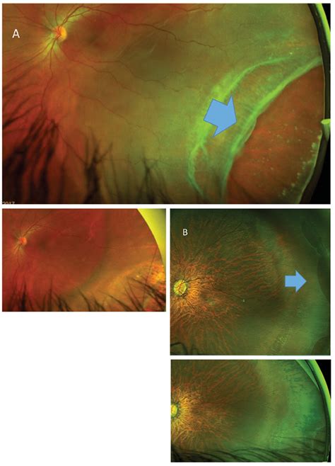 A Field Guide To Retinal Holes And Tears