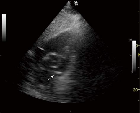 Subcostal Right Ventricular Inflow Outflow View Confirming Presence Of