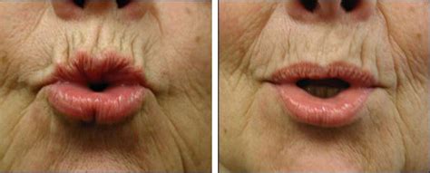 Botox Upper Lip Before And After