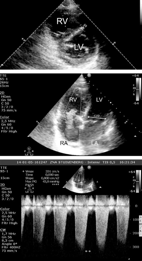 Cardiac Ultrasound In Cardiac Arrest Due To Pulmonary Embolism Panel A